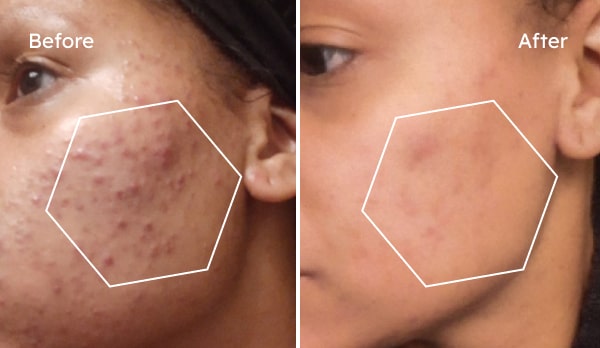 Before and after acne treatment results — Alea, inflammatory acne improved over 12 weeks