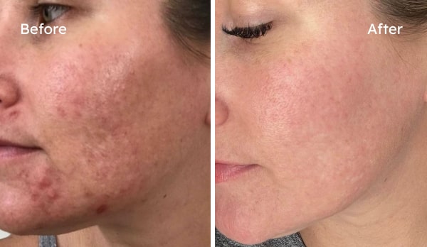 Before and after acne treatment results — Cait, hormonal acne cleared over 8 weeks