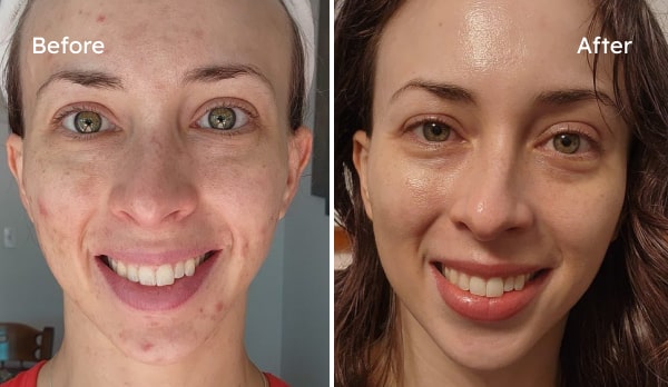 Before and after acne treatment results — Felicia, adult onset acne cleared over 6 weeks