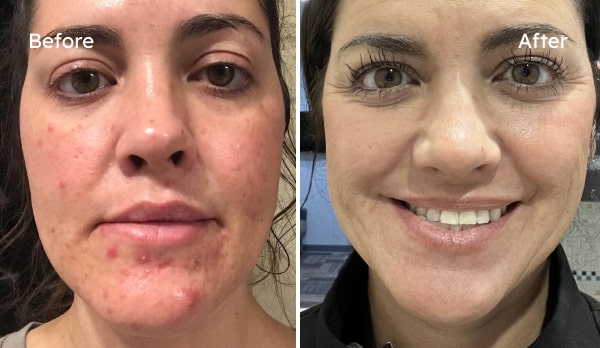 Kimberly C.'s skin before and after PROVEN — Acne · Redness