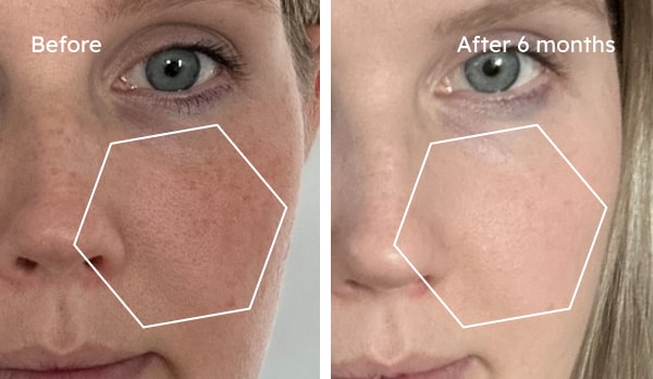 Before and after dry skin results showing improved hydration