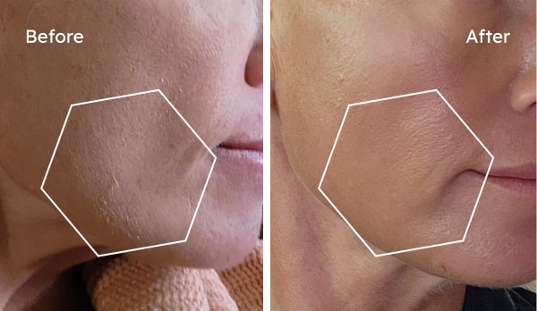 Before and after dry skin results showing a calmer barrier