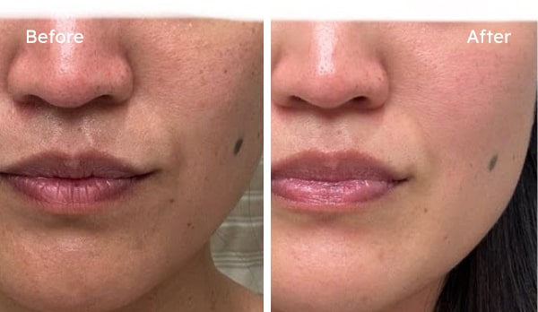 Before and after dry skin results showing smoother texture