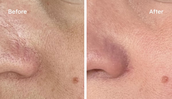 Before and after results for Fine lines & Wrinkles