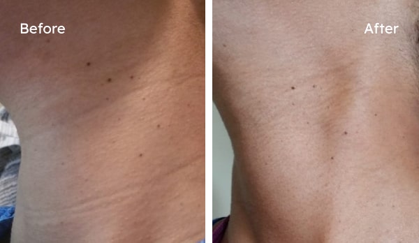 Before and after results for Fine lines & Wrinkles, Dryness