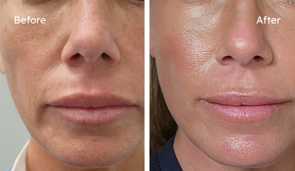 Before and after showing improved skin firmness for Meg after using PROVEN