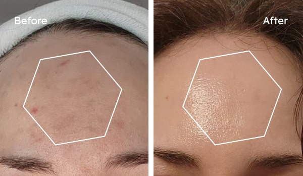 Before and after hyperpigmentation results — Felicia, sun-damage spots faded over 8 weeks