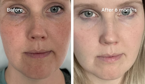 Before and after comparison — hyperpigmentation result
