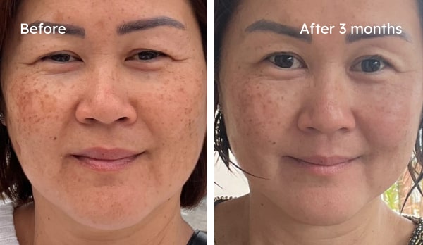 Before and after hyperpigmentation results — Silene, dark spots improved over 10 weeks