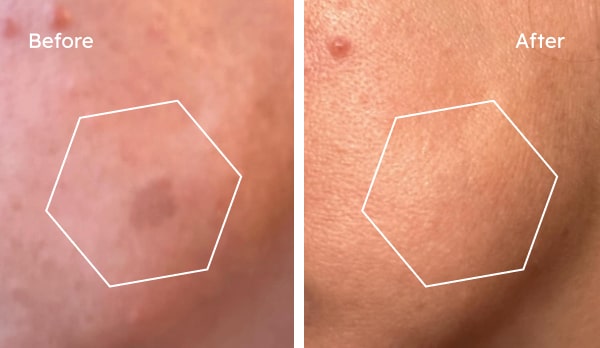 Before and after hyperpigmentation results — Suzy, age spots cleared over 12 weeks