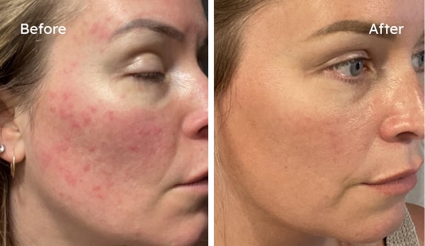 Katherine L.'s skin before and after PROVEN — Redness