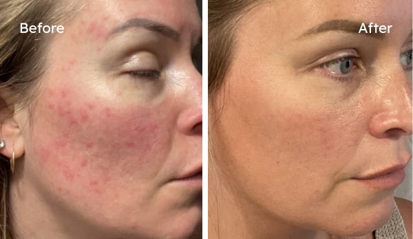 Customer Katherine before and after results