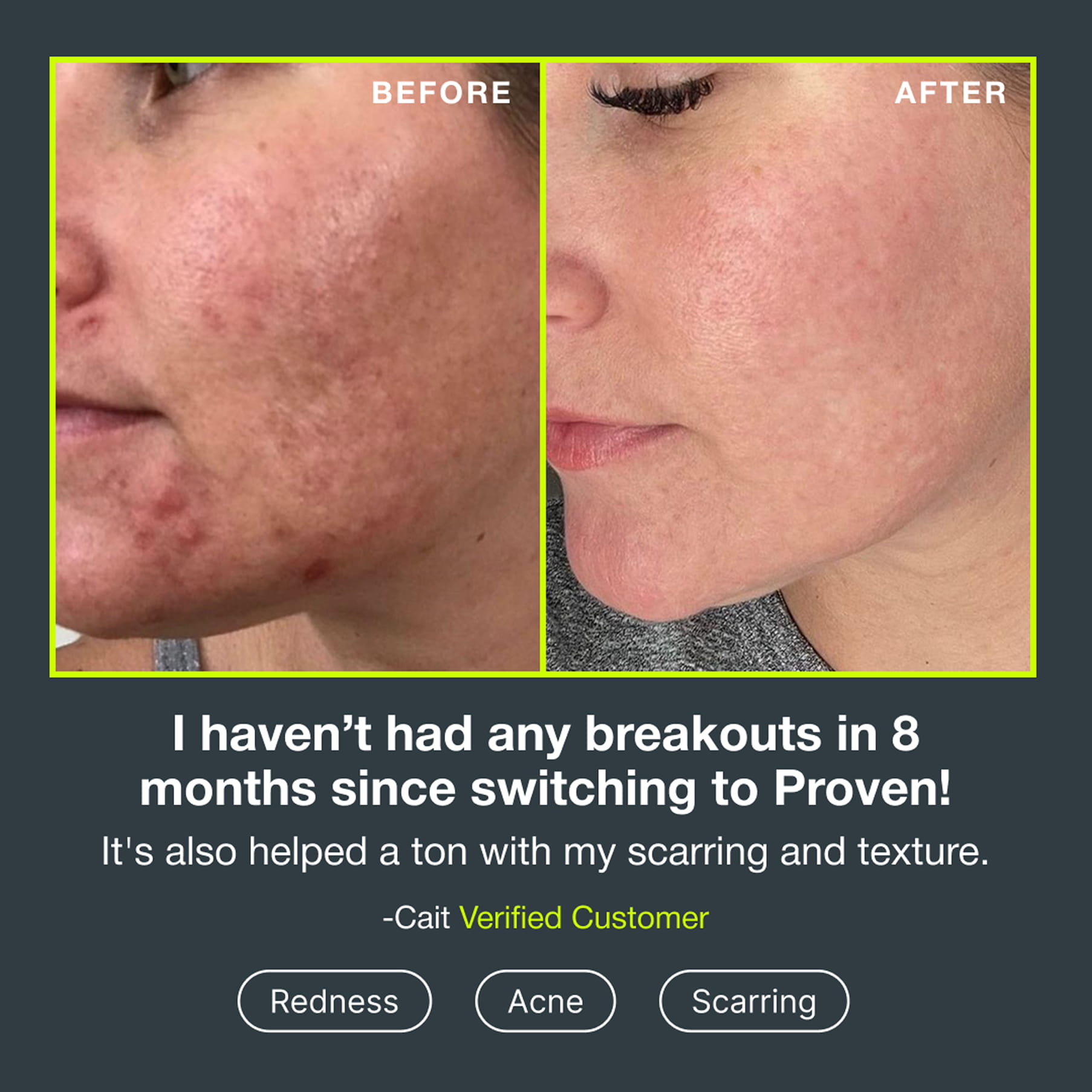 Before and after photographs of a customer’s cheek showing fewer breakouts, quoted: “I haven’t had any breakouts in 8 months since switching to Proven! It’s also helped a ton with my scarring and texture.” — Cait, verified customer, for redness, acne and scarring