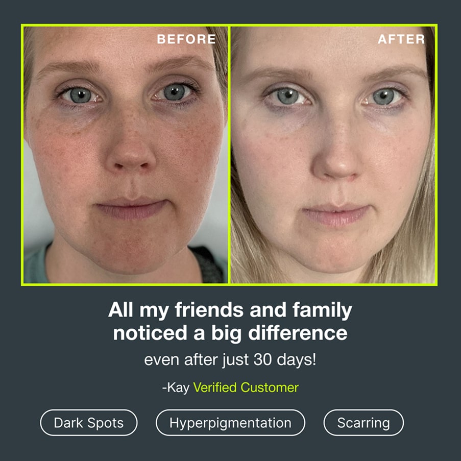 Before and after photographs of a customer’s face showing fewer dark spots, quoted: “All my friends and family noticed a big difference even after just 30 days!” — Kay, verified customer, for dark spots, hyperpigmentation and scarring